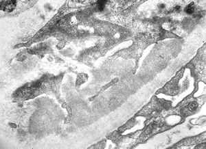 M,9y. | IgA nephropathy M,9y. | IgA nephropathy